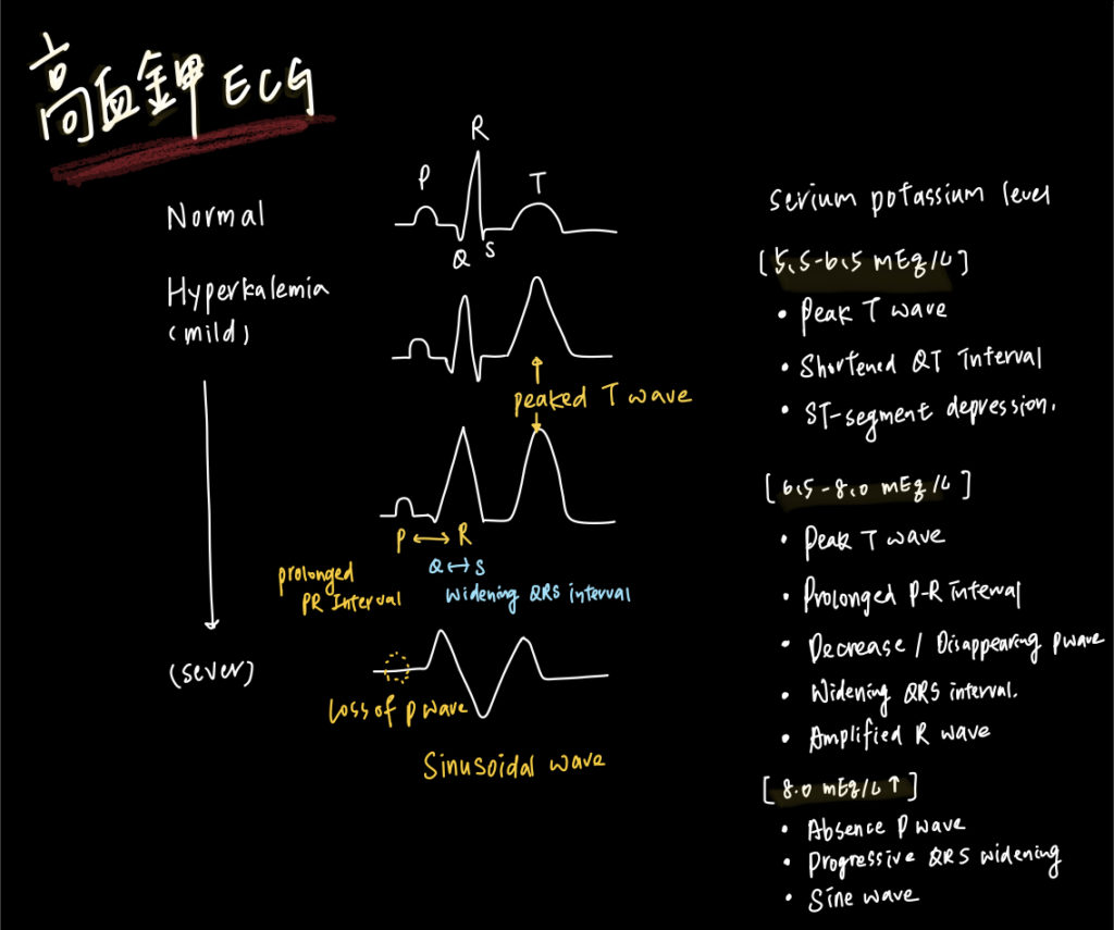 高血鉀ECG